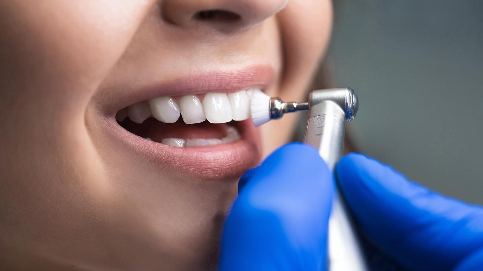 teeth whitening
